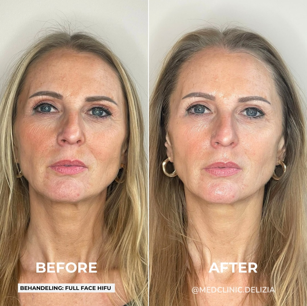 HIFU resultaat — verbeterde contour en stevigheid