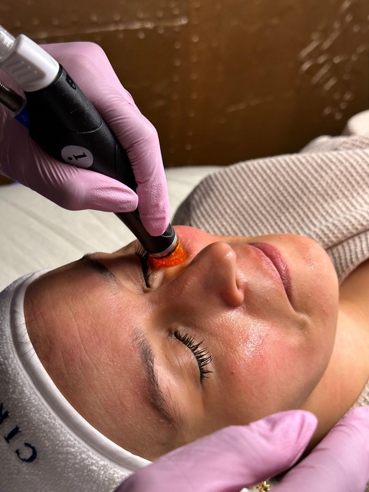 HydraFacial resultaat in Antwerpen na de behandeling, huid straalt
