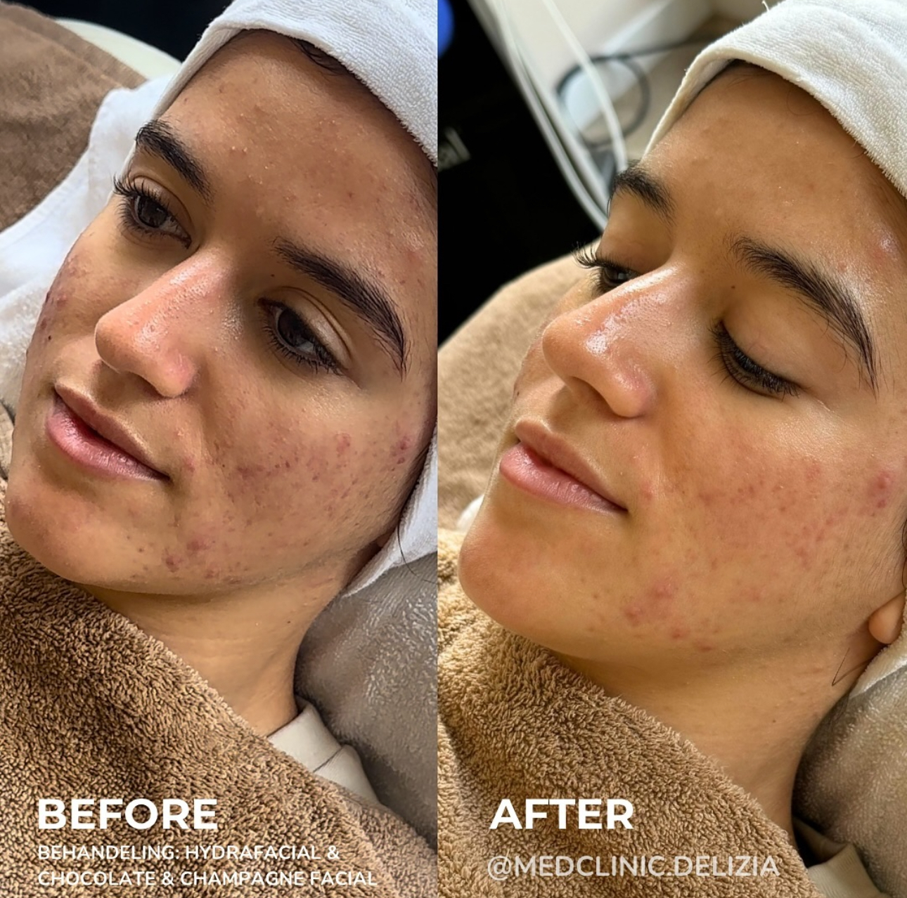 HydraFacial voor en na — directe glow, vrouw 34j