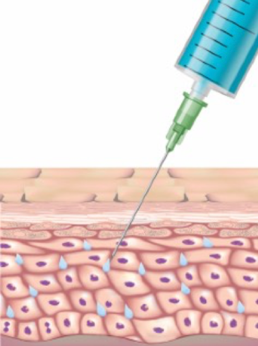 Skin Booster behandeling resultaat vergelijking