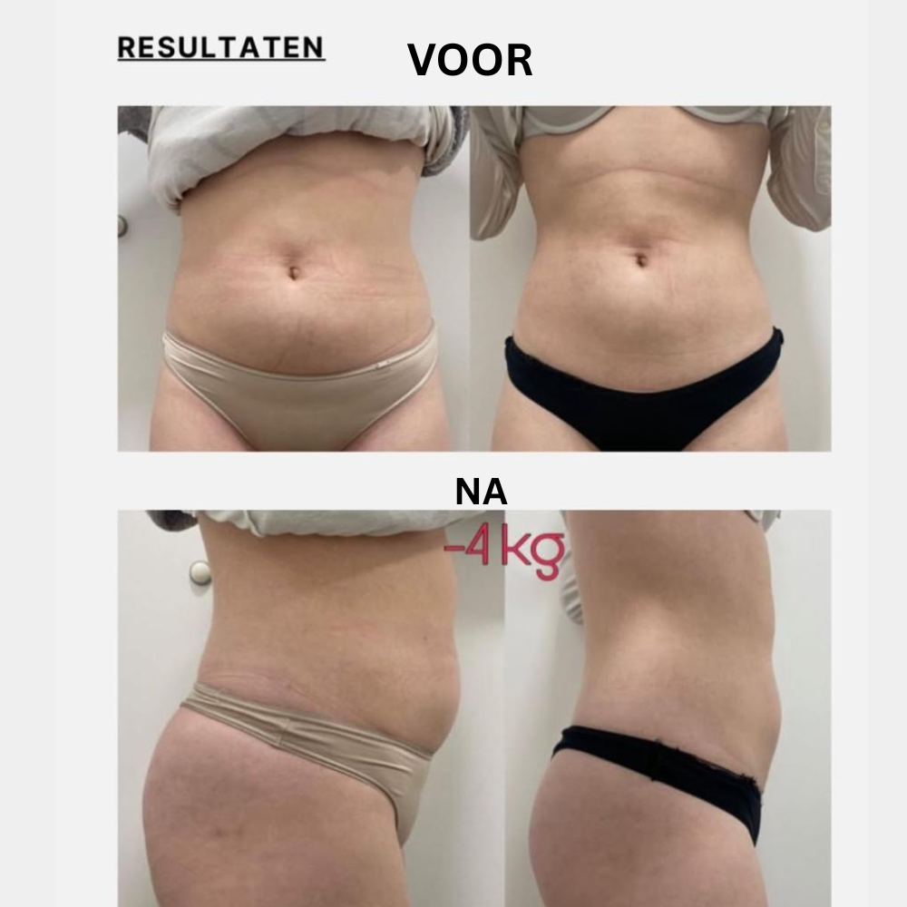 CoolSculpting Antwerpen voor en na resultaten — vetbevriezing buik en dijen