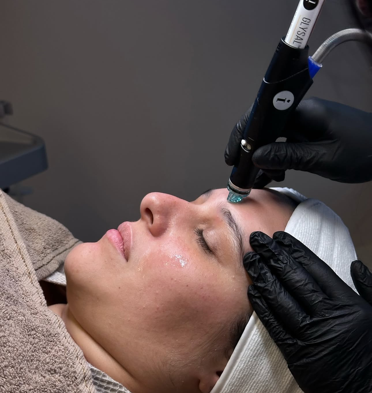 HydraFacial tijdens behandeling — reiniging, exfoliatie en hydratatie