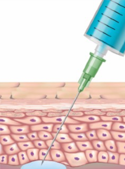 Fillers behandeling resultaat vergelijking